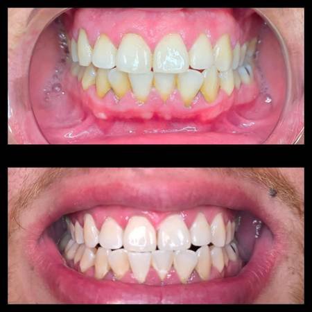 Teeth Whitening! Let&#039;s Brighten Up Your Smile (San Fernando Valley, Simi Valley, Santa Clarita, LA)s